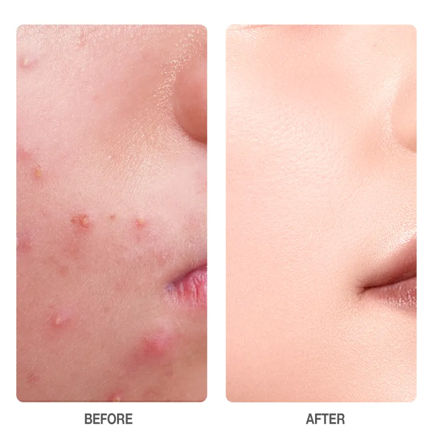 Skinever SALICYLIC ACID ACNE Treatment Ice Sleep Masque 55ml